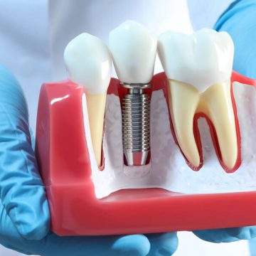 Why Choose Dental Implants to Replace Teeth? 