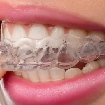 Why Clear Aligners Feel More Comfortable Than Traditional Braces