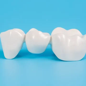 Types of Dental Bridges and How They Improve Your Smile