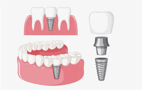 Dental Implants: Preferred Method for Tooth Replacement