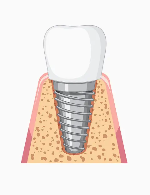 Types of Dental Implants We Offer