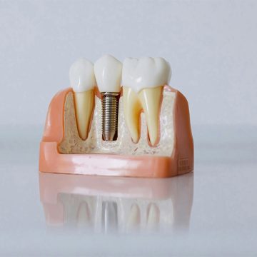 What Is the Recovery Time After Getting Dental Implants?
