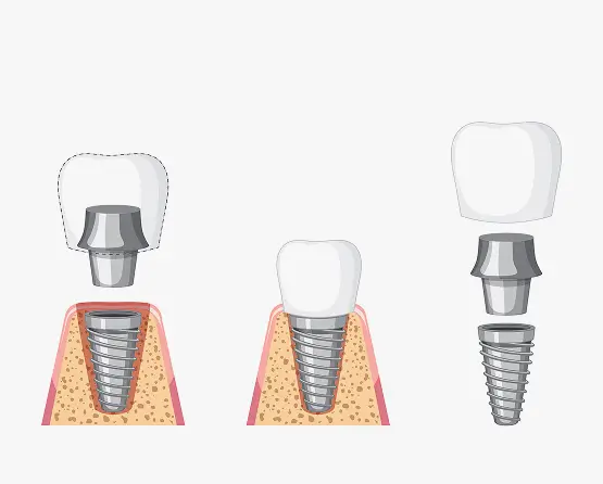 Why Choose Bayport Dental Care for Dental Implants in Bayport, NY