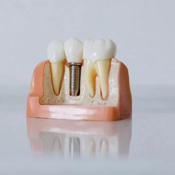 Here’s How to Take Care of Dental Implants